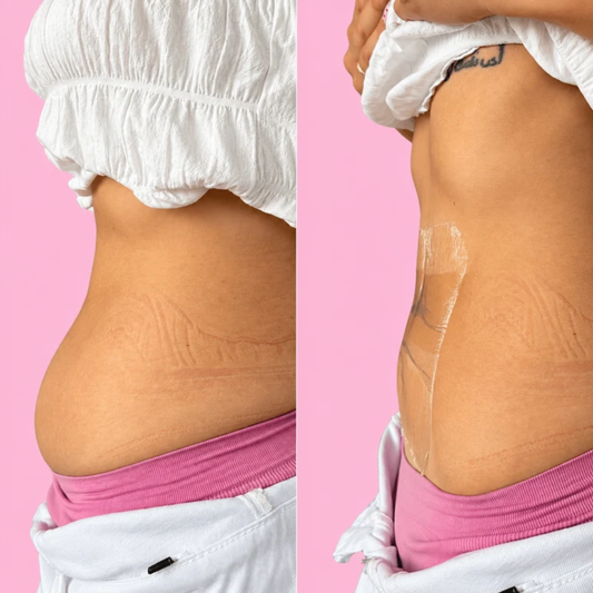 Alvanea™ – Bauch-Lifting-Tapes (10 Stück)